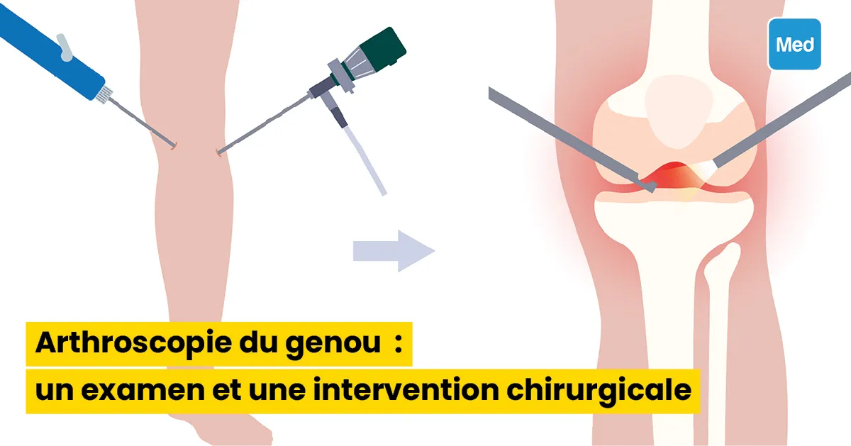 Arthroscopie du genou : un examen et une intervention chirurgicale